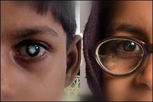 NYU Abu Dhabi Study Identifies Brain Structures that Underlie Sight Recovery in Blind Teenagers