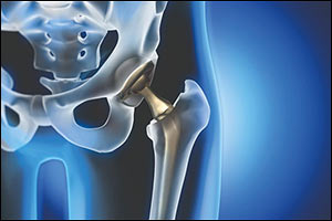 Falling on Artificial Hip Joint Fractures Saudi Lady Pelvis