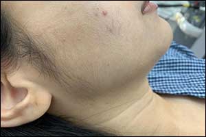 My Review Of Laser Treatment And Spider Veins