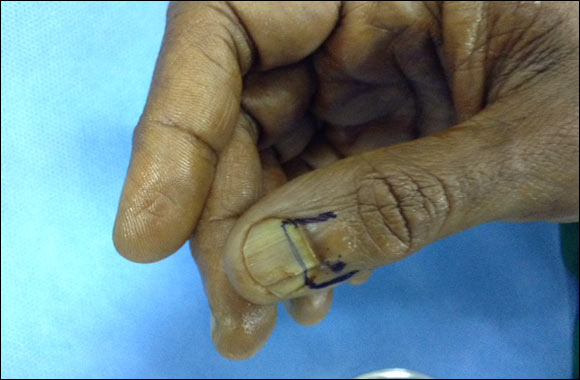 Rare tumour treated due to high clinical acumen of the Plastic Surgeon