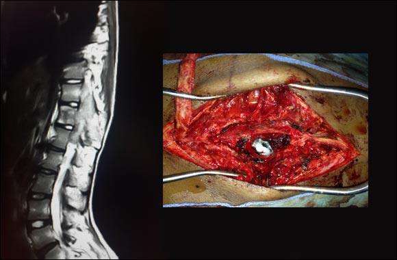 Rare �Spinal Tumor� removed successfully in paralysed teenage Nigerian girl