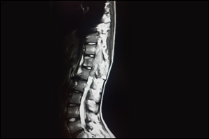 Rare “Spinal Tumor” removed successfully in paralysed teenage Nigerian girl
