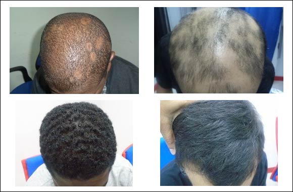 Some cases in which stress gave Alopecia Areata and others Alopecia Aareata gave anxiety and stress.